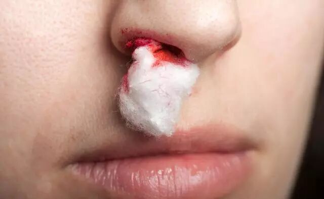 身体好不好 看鼻子就知道 这种鼻塞 可能是癌症 中推联合医学研究院韩雪 微信公众号文章阅读 Wemp