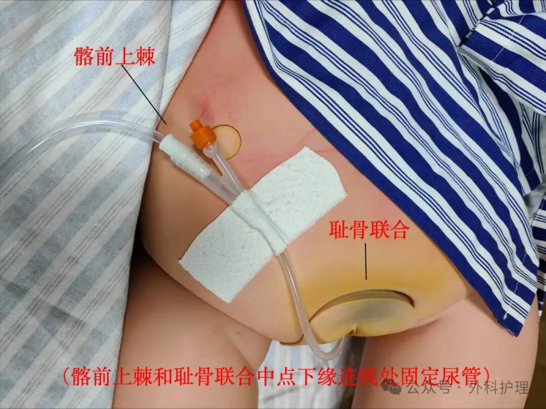 尿管怎么固定护士，导尿管二次固定位置你可能选错了！_https://www.jmylbn.com_新闻资讯_第9张