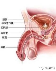 三腔导尿管怎么使用护士，下了尿管以后为啥我尿里有血，还总想尿尿啊？_https://www.jmylbn.com_新闻资讯_第2张
