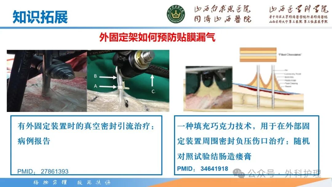 为什么负压引流【PPT】密闭式负压封闭引流技术相关知识_https://www.jmylbn.com_新闻资讯_第41张