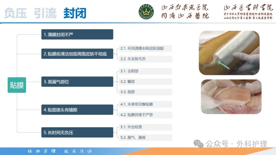 为什么负压引流【PPT】密闭式负压封闭引流技术相关知识_https://www.jmylbn.com_新闻资讯_第38张
