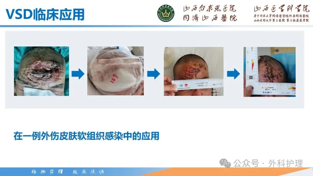 为什么负压引流【PPT】密闭式负压封闭引流技术相关知识_https://www.jmylbn.com_新闻资讯_第14张