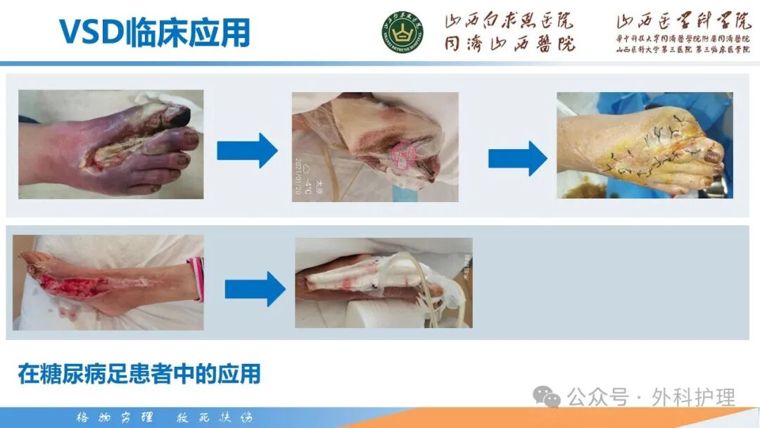 为什么负压引流【PPT】密闭式负压封闭引流技术相关知识_https://www.jmylbn.com_新闻资讯_第12张