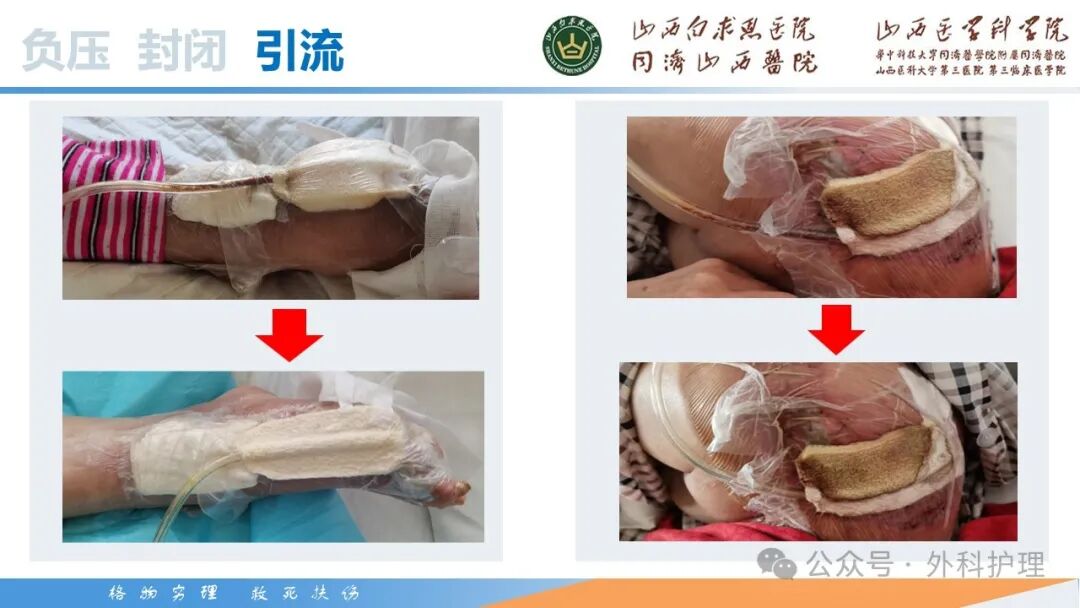 为什么负压引流【PPT】密闭式负压封闭引流技术相关知识_https://www.jmylbn.com_新闻资讯_第37张