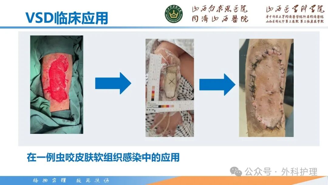 为什么负压引流【PPT】密闭式负压封闭引流技术相关知识_https://www.jmylbn.com_新闻资讯_第13张