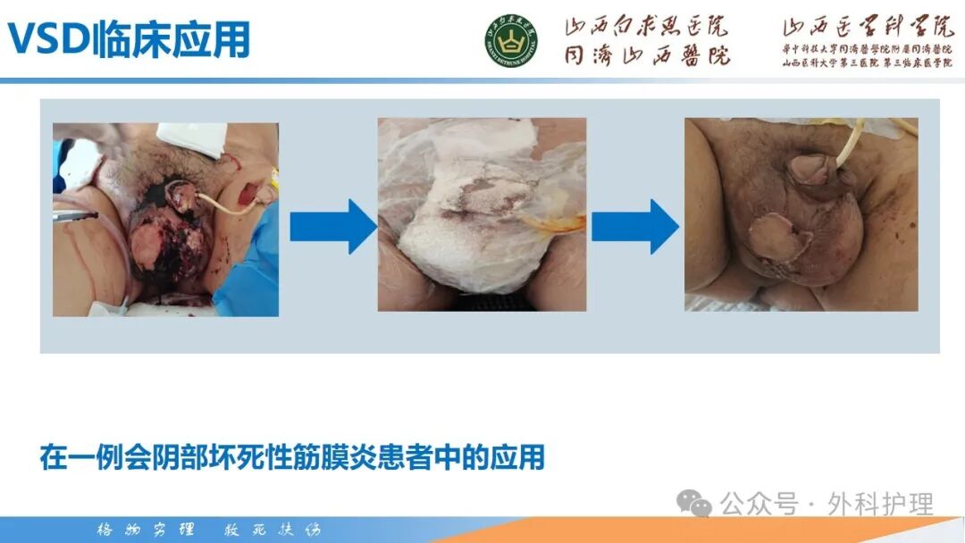 为什么负压引流【PPT】密闭式负压封闭引流技术相关知识_https://www.jmylbn.com_新闻资讯_第15张