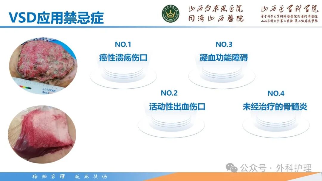 为什么负压引流【PPT】密闭式负压封闭引流技术相关知识_https://www.jmylbn.com_新闻资讯_第18张