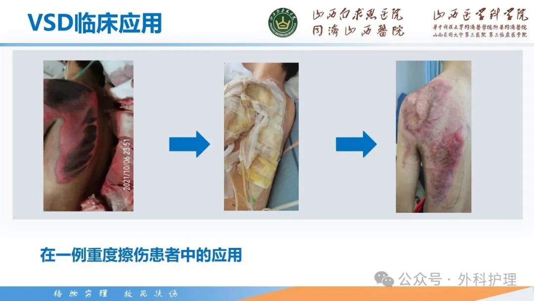 为什么负压引流【PPT】密闭式负压封闭引流技术相关知识_https://www.jmylbn.com_新闻资讯_第16张