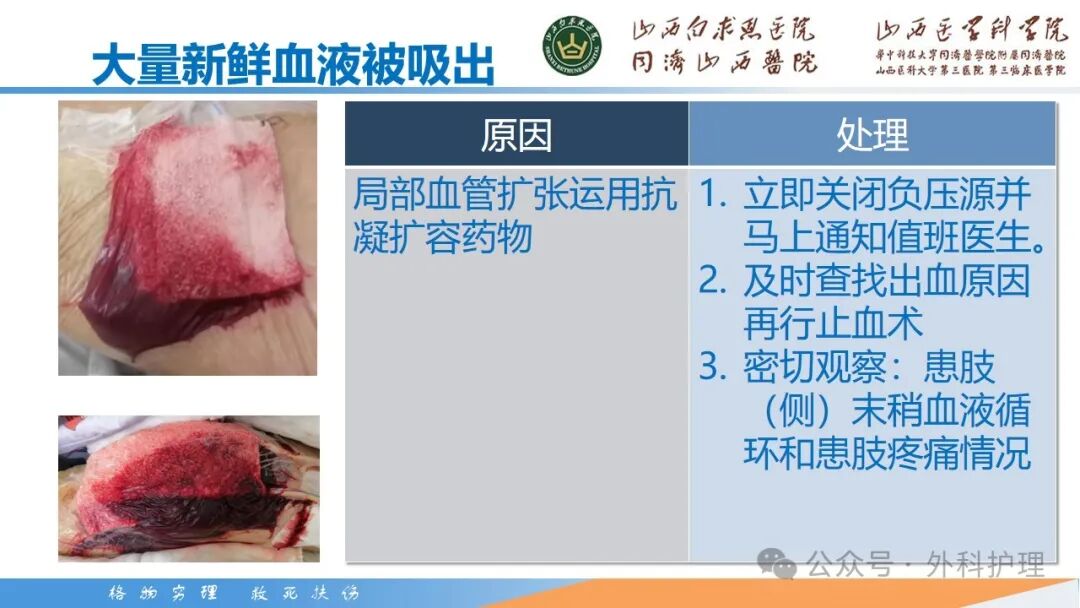 为什么负压引流【PPT】密闭式负压封闭引流技术相关知识_https://www.jmylbn.com_新闻资讯_第29张