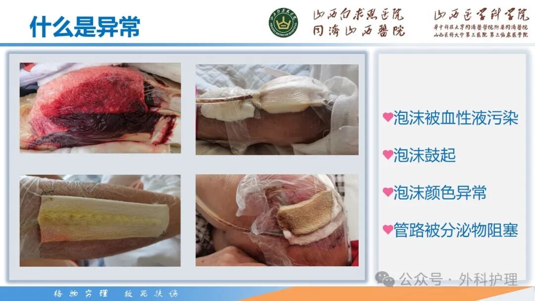 为什么负压引流【PPT】密闭式负压封闭引流技术相关知识_https://www.jmylbn.com_新闻资讯_第21张