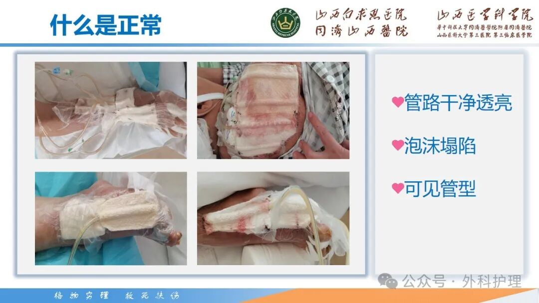 为什么负压引流【PPT】密闭式负压封闭引流技术相关知识_https://www.jmylbn.com_新闻资讯_第20张