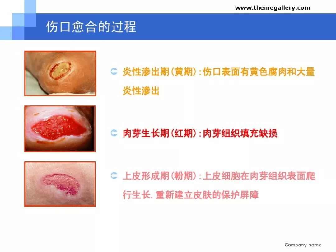 【ppt】伤口的愈合及护理