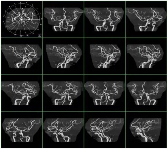 X光拍片为什么要等都是拍片，DR、CT、MRI，到底啥区别？_https://www.jmylbn.com_新闻资讯_第13张