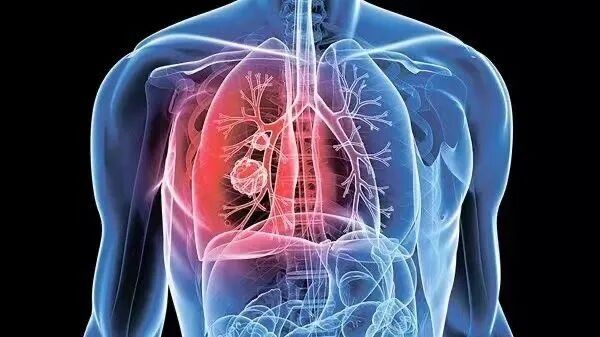 【健康新生活】肺部筛查有"利器"