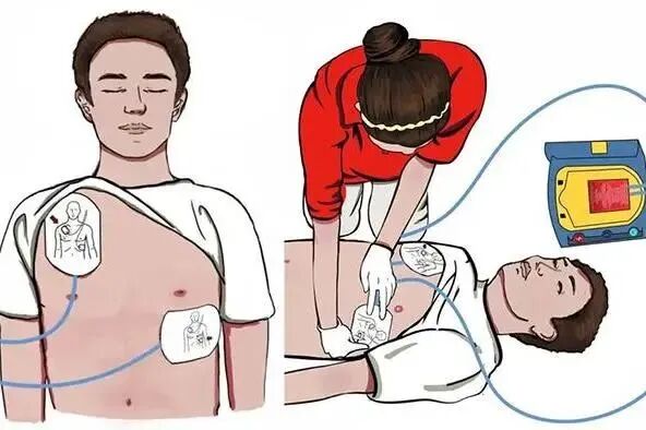 aed电极贴怎么贴人人都学习丨AED如何使用？_https://www.jmylbn.com_新闻资讯_第2张