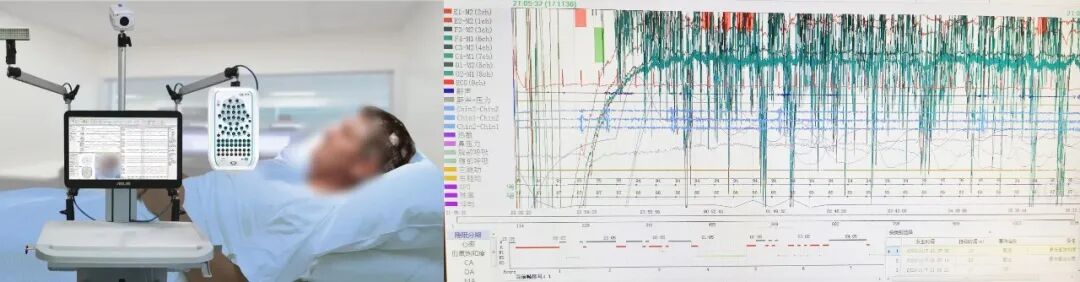 呼吸睡眠监测仪怎么用科普宣教 ｜ 睡眠困扰如何解决？带您一起了解睡眠监测_https://www.jmylbn.com_新闻资讯_第4张