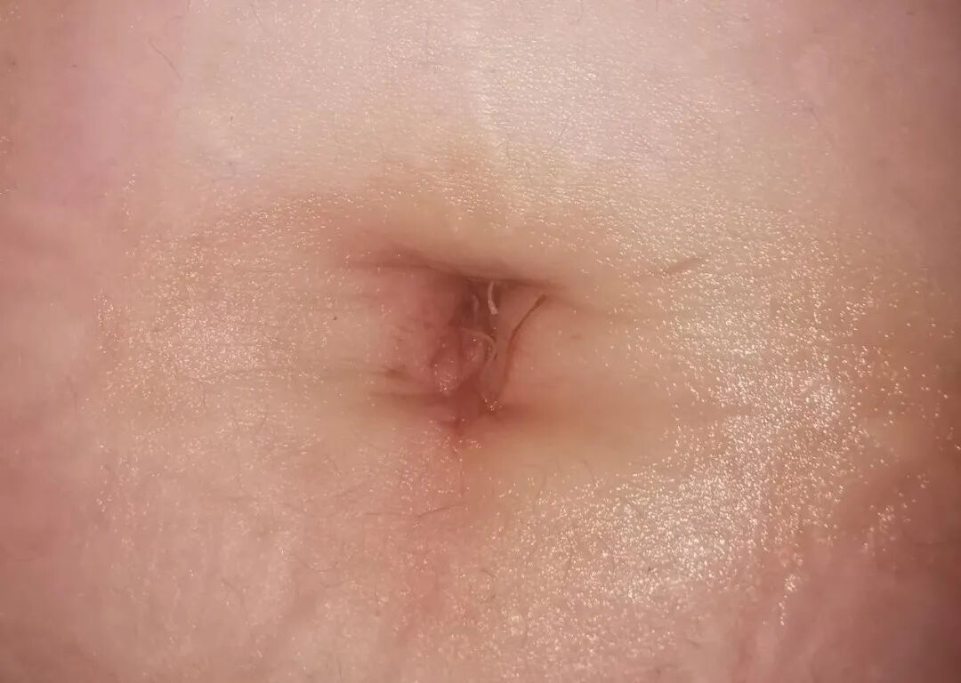 开刀孔怎么开刀宫外孕，害怕开刀留疤？肚脐上打一个小孔，就能手术_https://www.jmylbn.com_新闻资讯_第4张