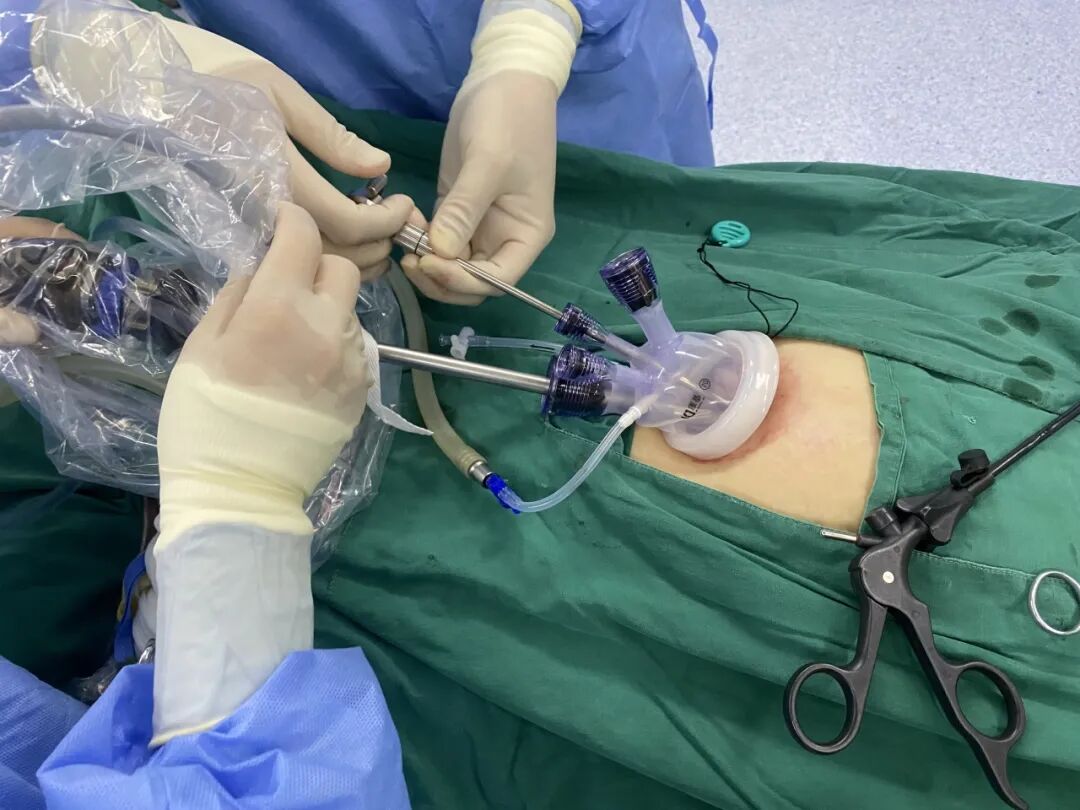 开刀孔怎么开刀宫外孕，害怕开刀留疤？肚脐上打一个小孔，就能手术_https://www.jmylbn.com_新闻资讯_第2张