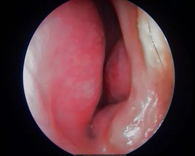 你知道什么是“蛙鼻”吗？