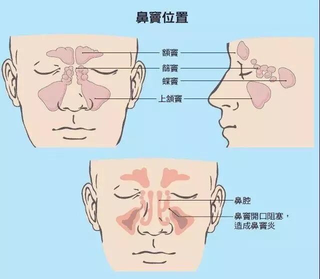 一起来了解一下鼻窦炎的危害