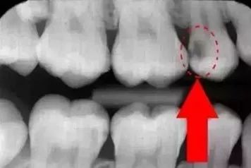 曲面断层片怎么看科普知识：你会看牙片嘛？今天手把手教你看！_https://www.jmylbn.com_新闻资讯_第14张