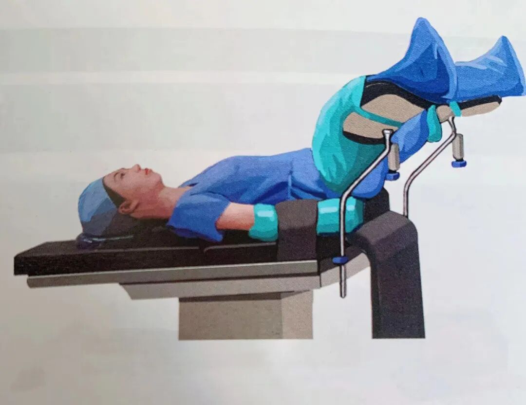 妇科手术床怎么座妇幼科普 | 盘点手术室的那些“体位”技术活儿_新闻资讯_第4张_活检穿刺产品网 妇科手术床怎么座妇幼科普 | 盘点手术室的那些“体位”技术活儿_https://www.jmylbn.com_新闻资讯_第4张