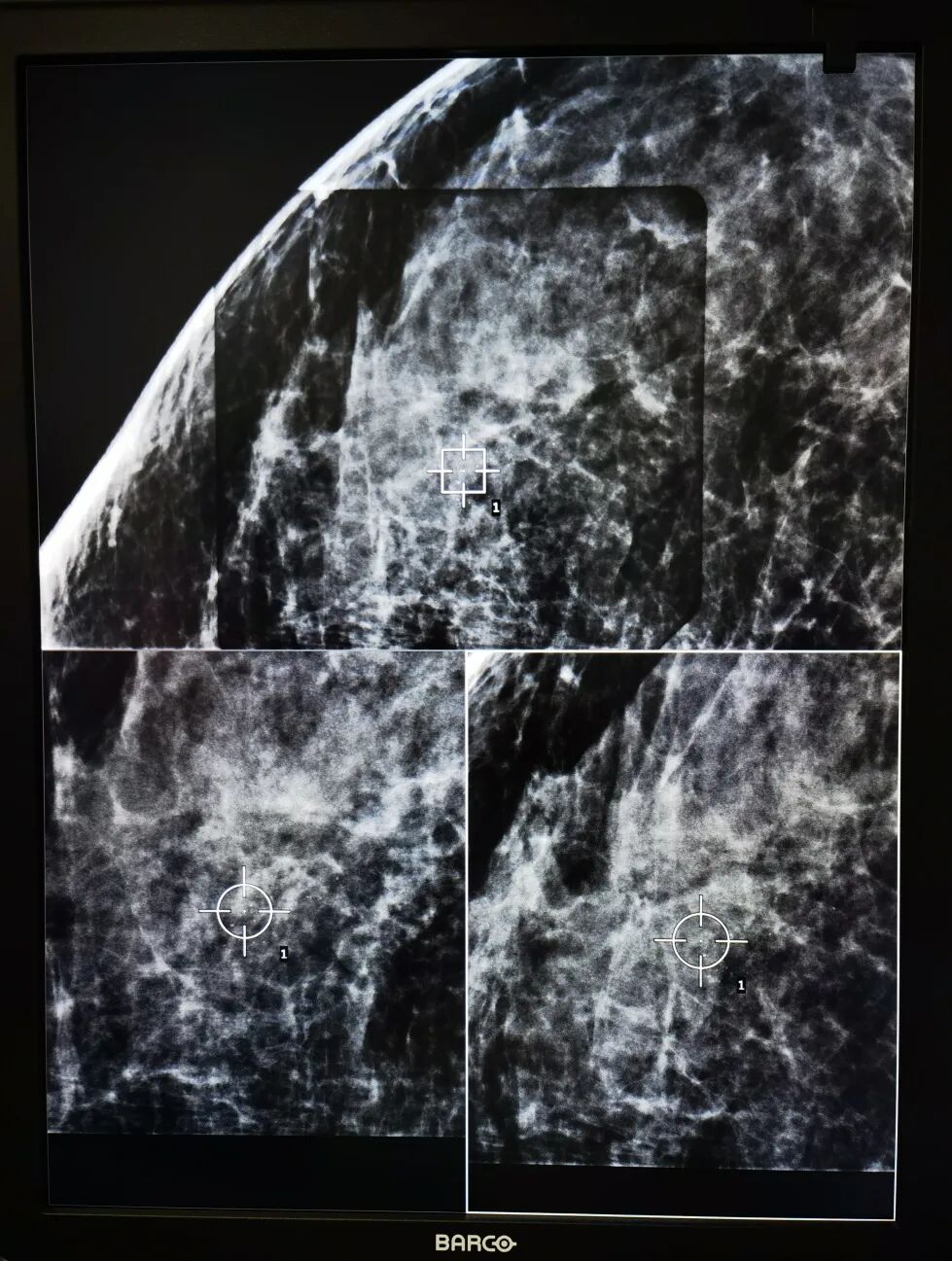 数字钼靶是什么精准+微创：X线数字断层摄影立体定位的乳腺穿刺活检技术_https://www.jmylbn.com_新闻资讯_第6张