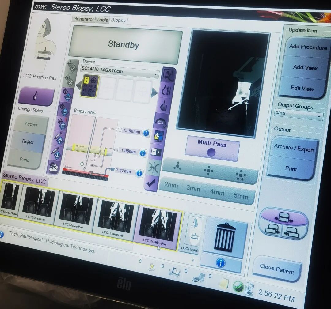 数字钼靶是什么精准+微创：X线数字断层摄影立体定位的乳腺穿刺活检技术_https://www.jmylbn.com_新闻资讯_第3张