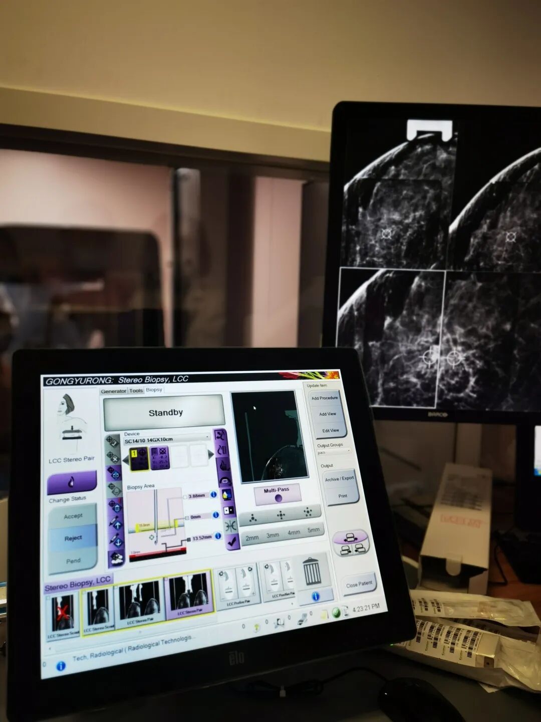 数字钼靶是什么精准+微创：X线数字断层摄影立体定位的乳腺穿刺活检技术_https://www.jmylbn.com_新闻资讯_第5张