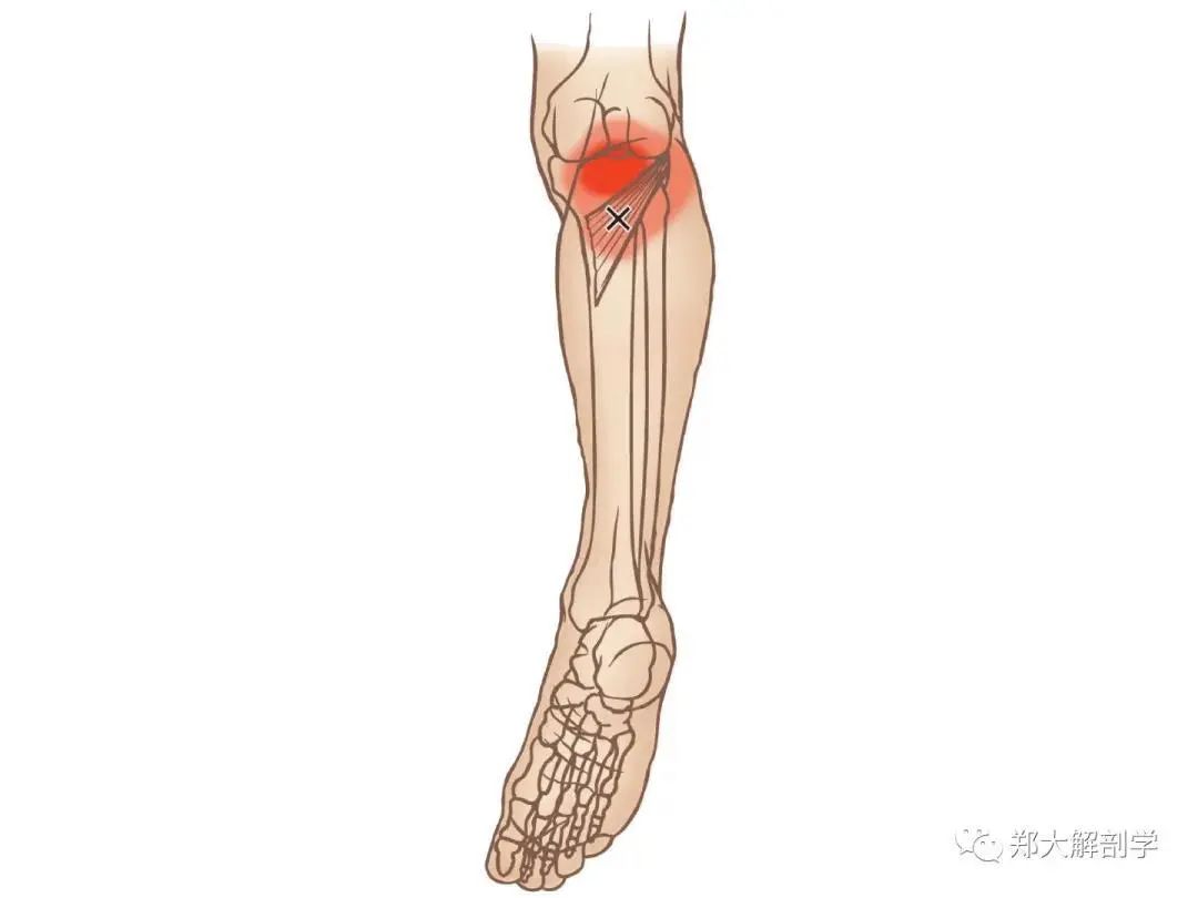 身体肌肉扳机点位置、成因与症状分析（深度好文）