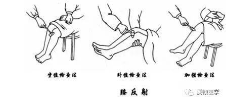 hoffmann徵:即霍夫曼氏徵,由c7-t1支配,經正中神經傳導.