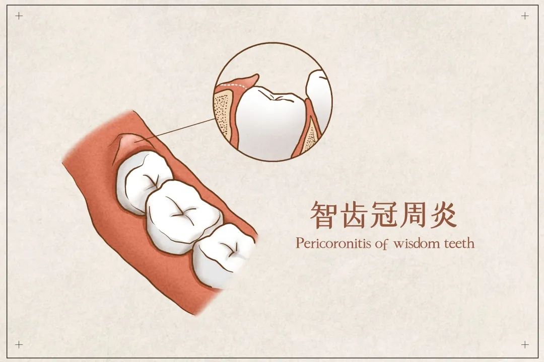 科普長了智齒該不該拔這6類人別隨意拔嚴重時可危及生命