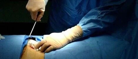 一文梳理：肝活检的术前准备及各类方法