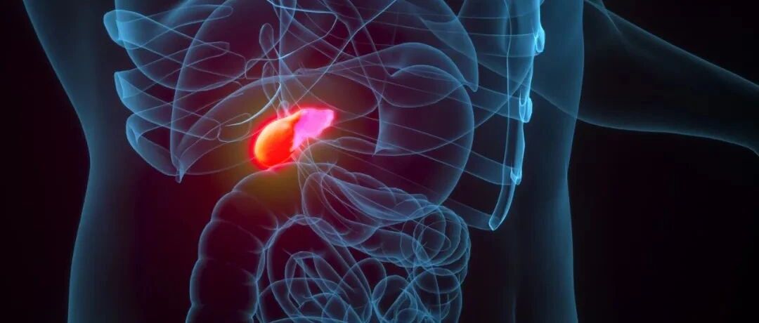 腹腔镜胆囊切除术：6大常见并发症及预防方法