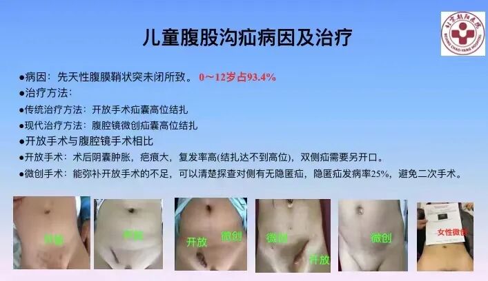 s拉钩怎么用拉钩好几年，还是搞不懂腹股沟区的解剖层次？_https://www.jmylbn.com_新闻资讯_第14张