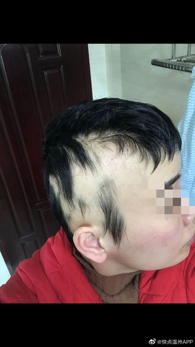 女子想治斑秃，越治越秃！太吓人了（图）