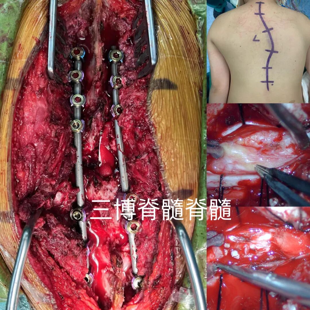 脊髓髓内畸胎瘤合并先天性脊柱发育畸形-脊柱侧弯一例