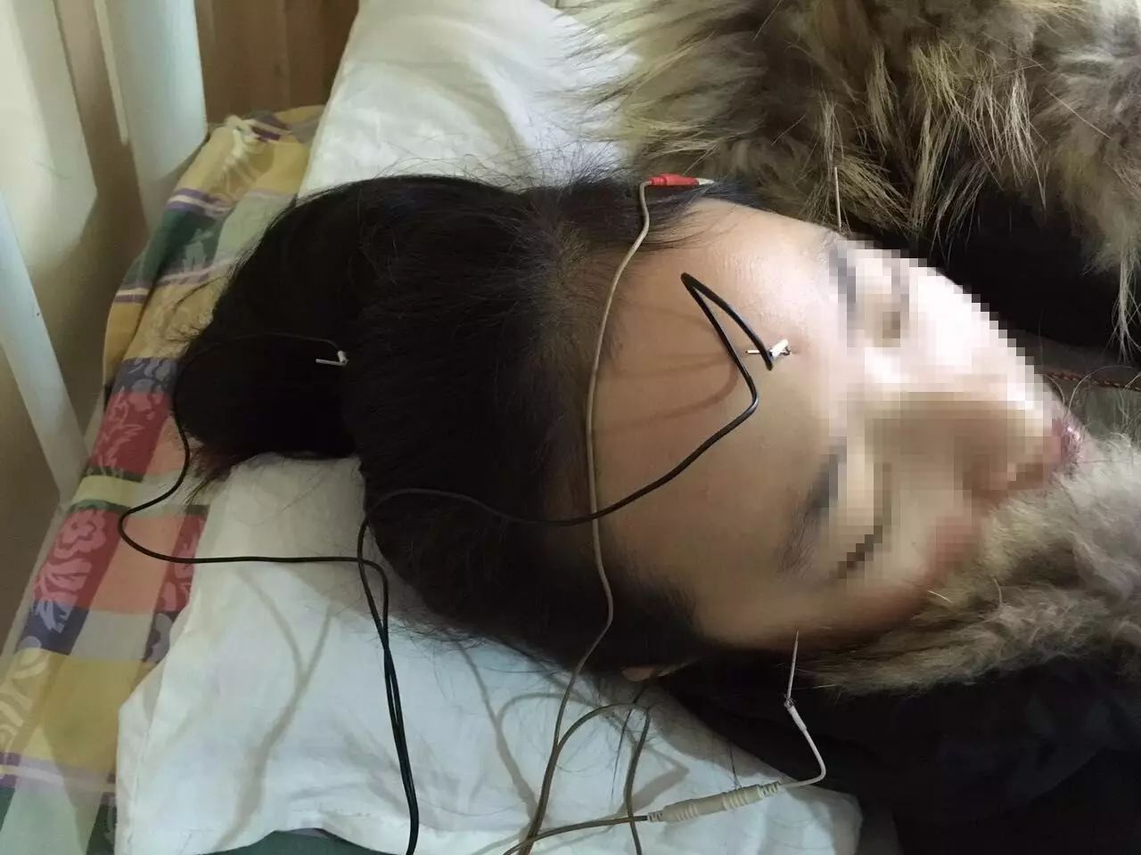 尤其是对于 18岁内假性近视的青少年,通过针灸治疗可以让他们恢复正常