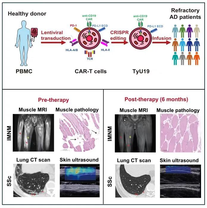 cell 图片 图1UCAR-T产品“TyU19”的设计和体内治疗效果.jpg