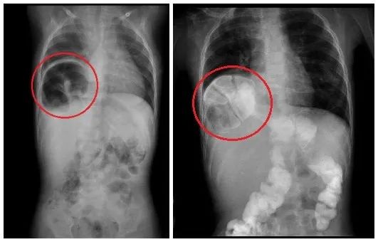 儿童幽门梗阻图片