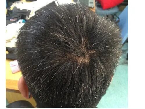 儿童及青年为何会白头？