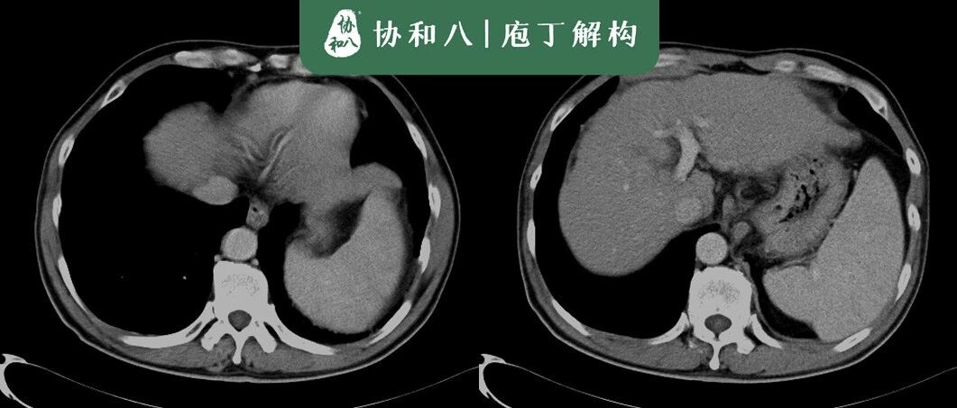 腹腔里的牛刀小试 | 协和八