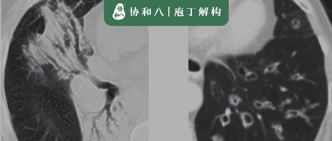 支气管怎么变粗了 | 协和八