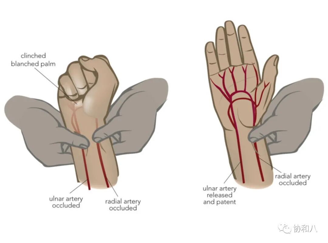 肝素帽为什么能抗凝一文掌握，动脉血气采集与各项指标的临床意义_https://www.jmylbn.com_新闻资讯_第3张