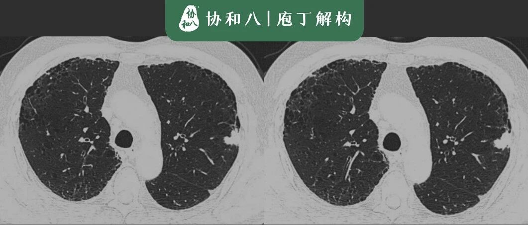 坏结节还是好结节？-胸部CT基本病变征象（一） | 协和八