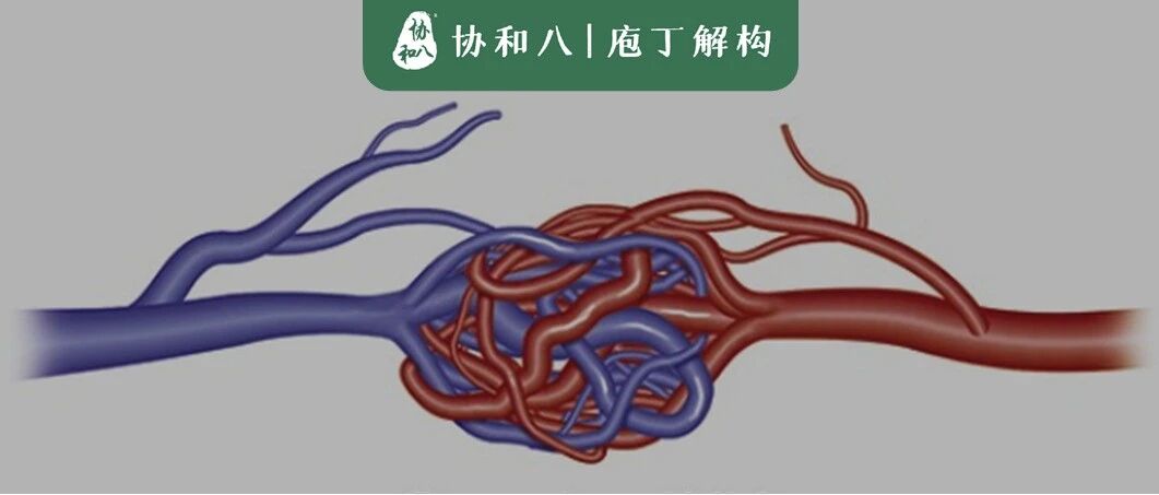 肺动静脉畸形 | 协和八