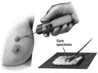 穿刺枪怎么升级乳腺穿刺术（三）_https://www.jmylbn.com_新闻资讯_第5张
