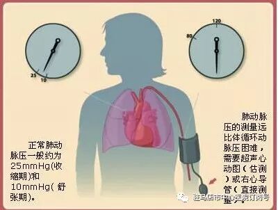 “伟哥”都治不住的“高压”