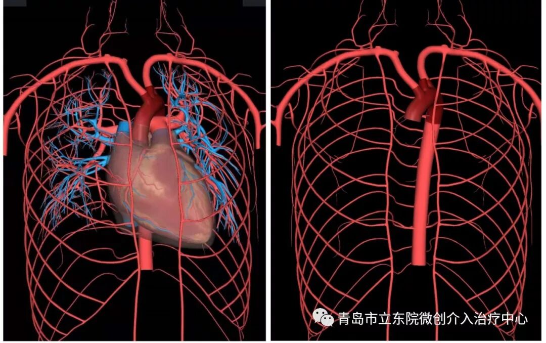 解剖图就会发现,患者不仅左侧锁骨下动脉慢性闭塞,主动脉的走行也异常