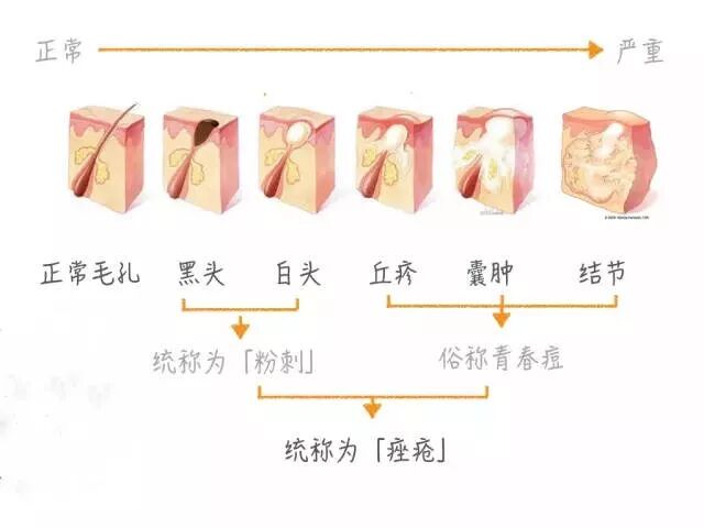 闭口痘痘的皮肤管理方法